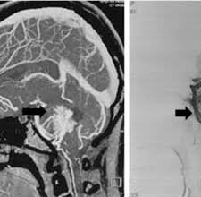 Neuroradiology's Role in Assessing Post-Surgical Outcomes