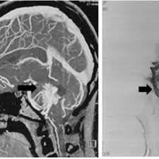 Neuroradiology's Role in Assessing Post-Surgical Outcomes