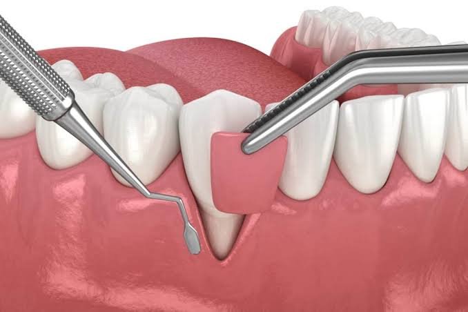 How a Periodontist Addresses Advanced Gum Issues