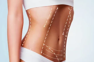 The Role of Liposuction in Body Contouring