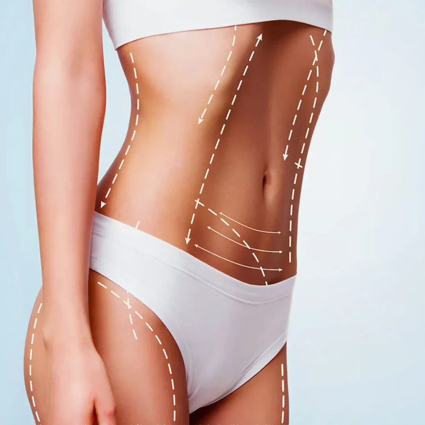 The Role of Liposuction in Body Contouring