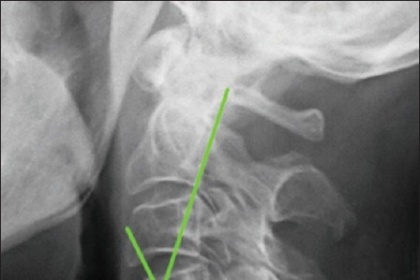 The Role of Spine Neurosurgeons in Sports-related Injuries