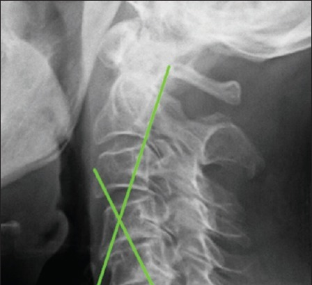 The Role of Spine Neurosurgeons in Sports-related Injuries