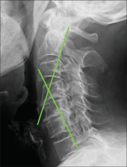 The Role of Spine Neurosurgeons in Sports-related Injuries